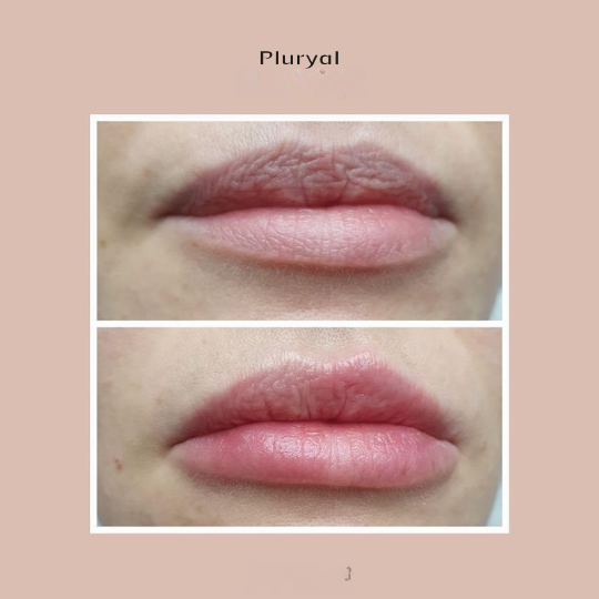 Sử dụng Pluryal Bioclassic trong tạo hình môi